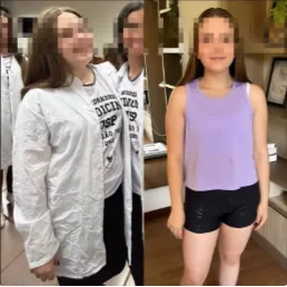 Antes e depois de paciente com acompanhamento nutricional