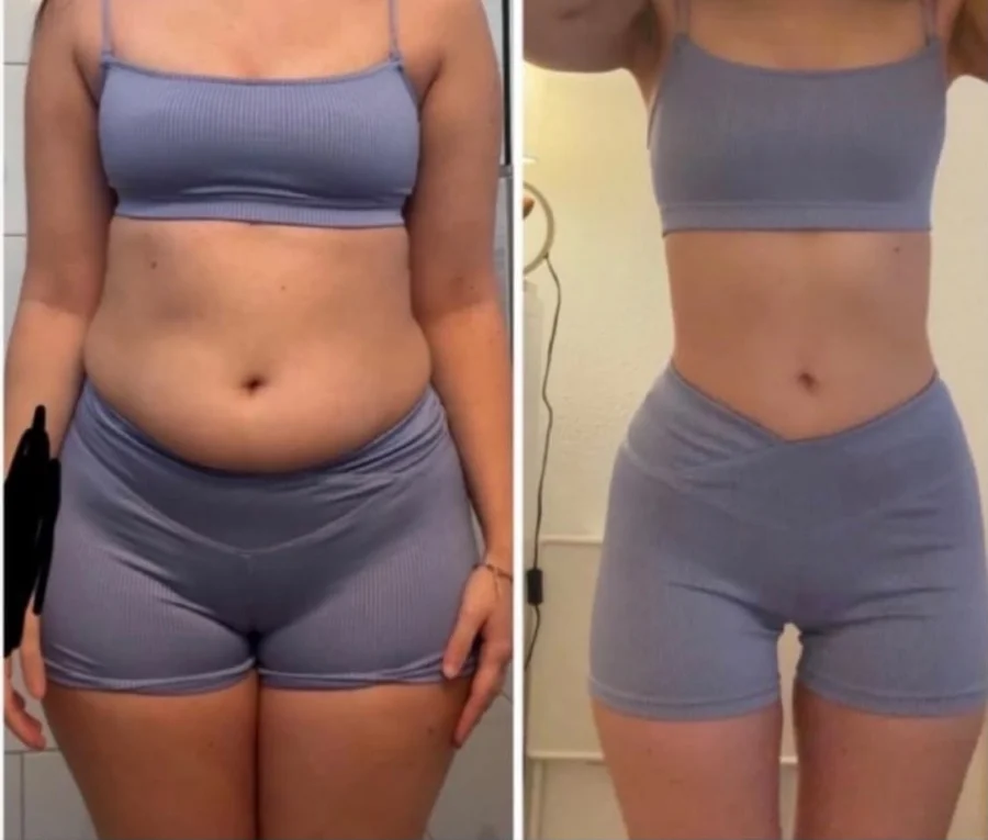 Antes e depois de paciente que definiu o abdômen com acompanhamento